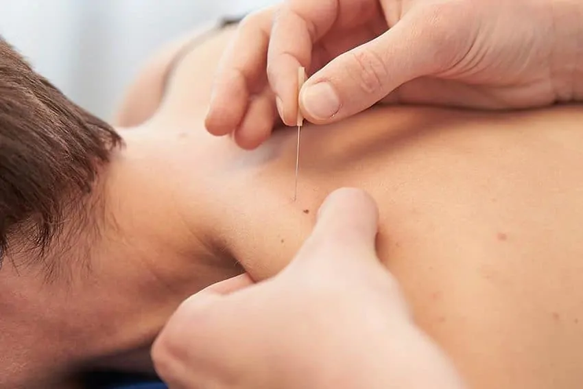 Acupuncture - Walsall Osteopath